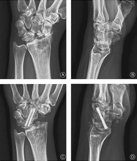 Lateral Approach For Scaphoid Excision And Capitolunate Arthrodesis In