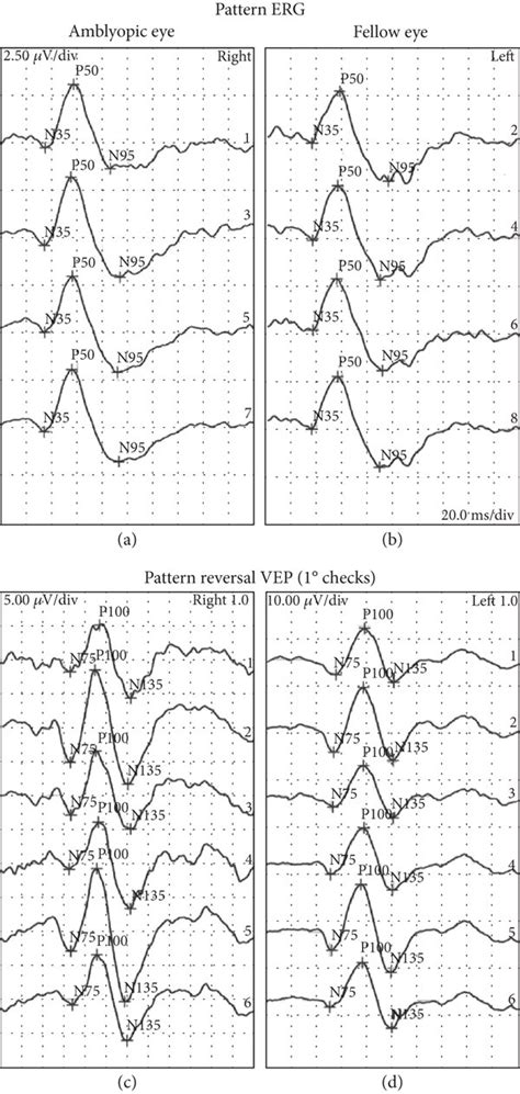 Pattern ERG A B And Pattern Reversal VEP C D Results For The