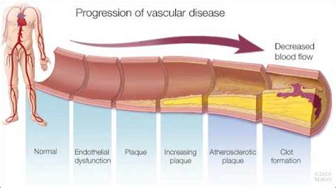 Mayo Clinic Q And A What Causes Erectile Dysfunction And Should It Be