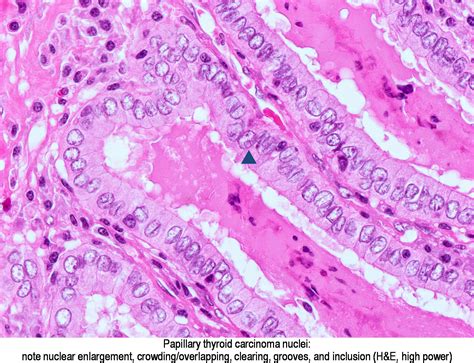 Pathology Outlines Papillary Thyroid Carcinoma Overview