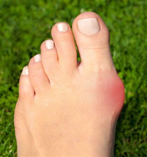 The Best Shoes For Bunions Hammertoes