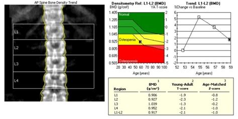 Bone Density Keystone Medical