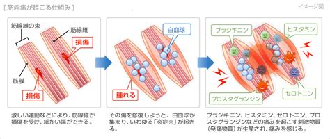 筋肉痛の症状・原因｜くすりと健康の情報局