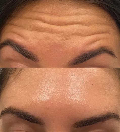 Best Forehead Line Treatment In Brisbane Cutis Dermatology