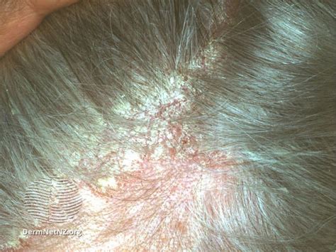 Scalp Atopic Dermatitis vs. Other Skin Conditions