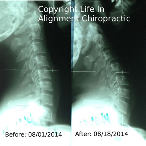 Reversal Cervical Lordosis