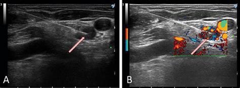 Neck Ultrasound Examination During Treatment Ultrasound Guided