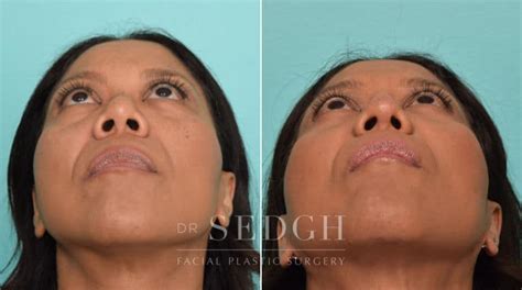 Asian Rhinoplasty Before After Photos Dr Sedgh