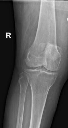 Bipartite Patella Radiology Case Radiopaedia Org