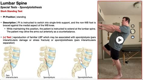 Stork Standing Test For Spondylolisthesis Rationale