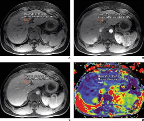 Figure 1 From MRI Arterial Enhancement Fraction In Hepatic Fibrosis And