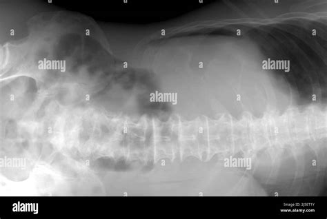 Lateral Left Decubitus Lld Abdominal X Ray Of A Patient With