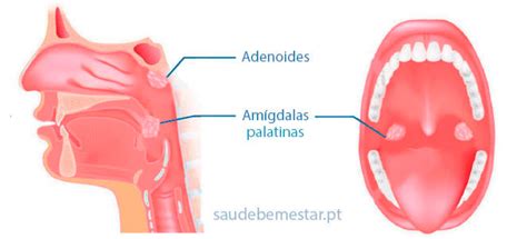 A Garganta Fica V Rias Vezes Inflamada Pode Ser Amigdalite De Repeti O
