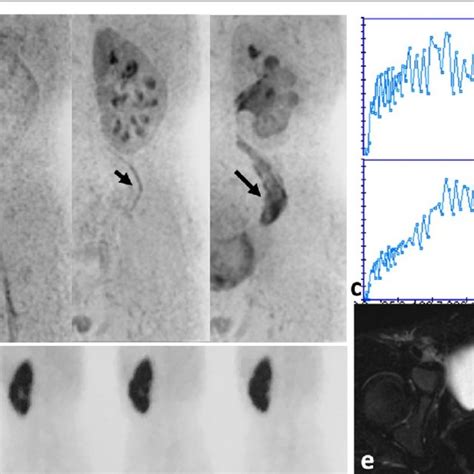 Different Grades Of Vesicoureteral Reflux Elicited By Micturating