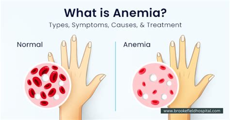 What All You Need To Know About Anaemia Brookefield Hospital