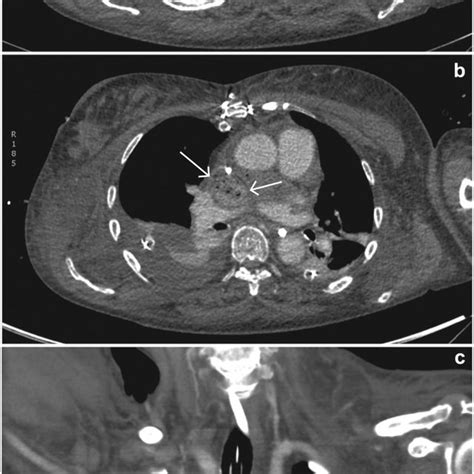 Contrast Enhanced Ct Scans Of The Same Patient As In Fig That Were