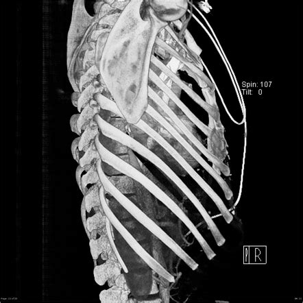 Flail Chest Diagram