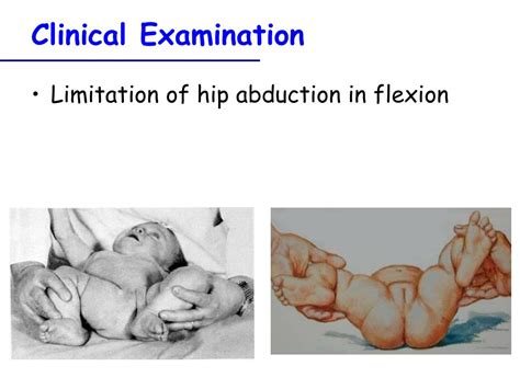 PPT CDH Congenital Dislocation Of The Hip PowerPoint Presentation