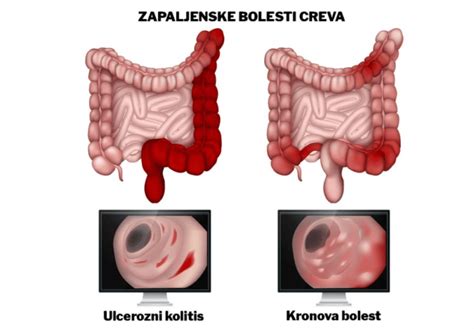 Kaj Je Ulcerozni Colitis Hood Si