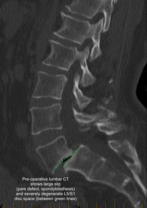 Grade Spondylolisthesis Pars Defect Isthmic Spondy C N S Neurosurgery