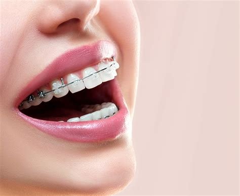 Orthodontist Clear Invisalign Braces In Stafford And Stoke On Trent