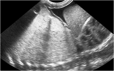 Fetal Lung Interstitial Tumor Case Sonography Of The Baby Boy On