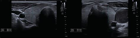 Thyroid Ultrasound Revealed Rare Bilateral Infracentimetric Nodules