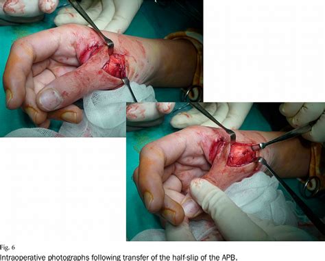 Figure 6 From Reconstruction Of Extensor Tendon Dislocation Due To