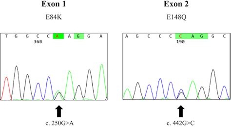 Figure3 A Sequencing Analysis Of The MEFV Gene DNA Sequencing Shows A