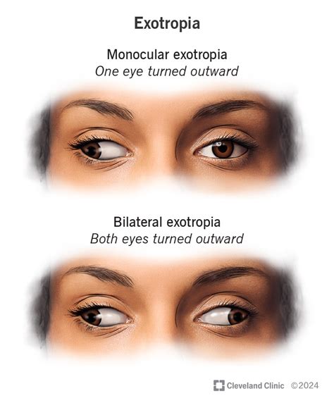 Exotropia Types Symptoms Causes And Treatment