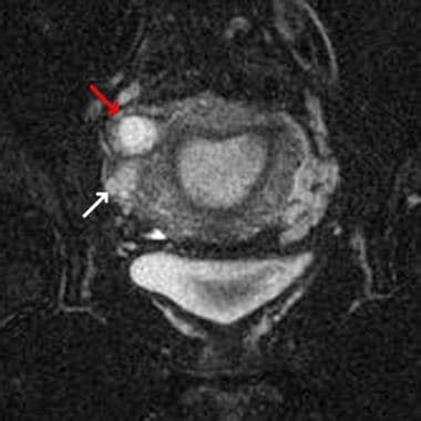 Ectopic Pregnancy Imaging Practice Essentials Magnetic Resonance