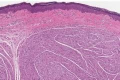 Circumscribed Solitary Neuroma Ottawa Atlas Of Pathology