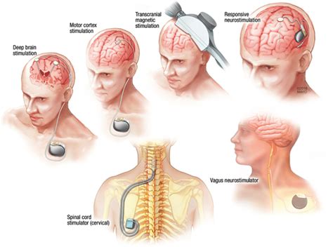 Frontiers Restoring Sensorimotor Function Through Off