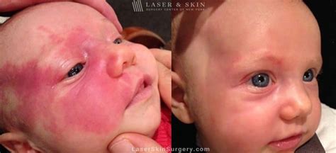 Birthmark Removal Before And After