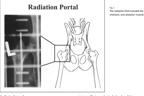 Figure 2 From Optimal Timing Of Preoperative Radiation For Prophylaxis Against Heterotopic