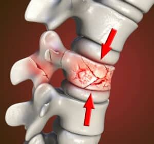 How Is A Spinal Compression Fracture Treated Nj Spine Orthopedic