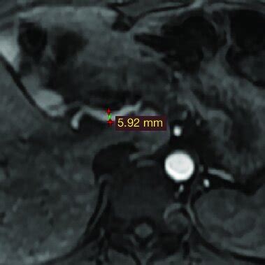 Gd EOB DTPA Enhanced MRI Showed Dilated And Tortuous Hepatic Arterial