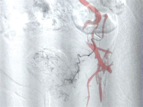 Embolisation De La Prostate Radiologie Interventionnelle