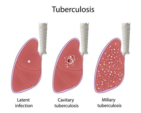 The True Burden Of Tuberculosis