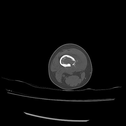 Osteosarcoma Image Radiopaedia Org