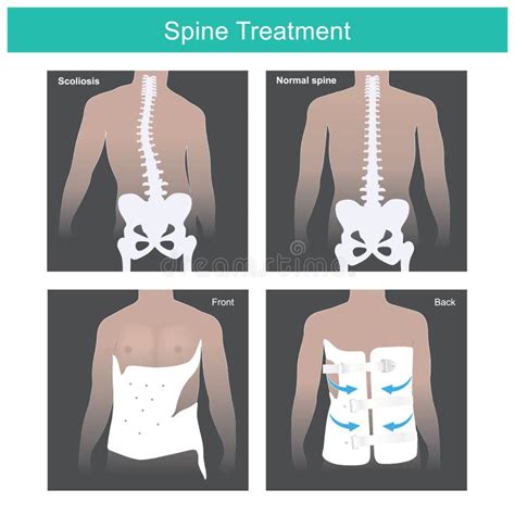 Spine Treatment. stock vector. Illustration of bone - 253622260