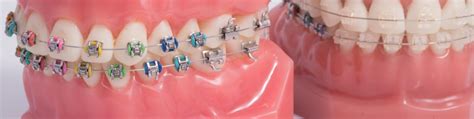 Multi attaches Dr Chavanne Orthodontiste à Palaiseau