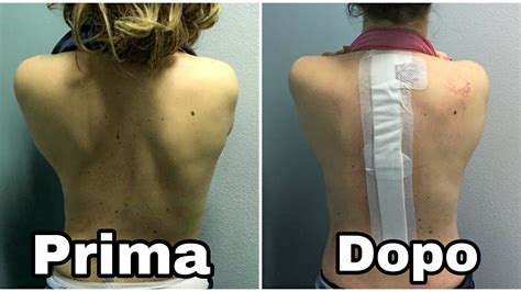 Scoliosis Surgery Operazione Scoliosi La Mia Esperienza