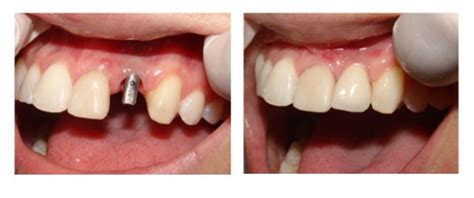 Patient Photos Dr Saurabhs Dental Clinic And Implant Center