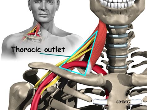 Thoracic Outlet Syndrome EOrthopod