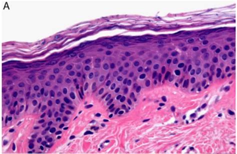 Dermatitis Por Hongos Malassezia Pachydermatis