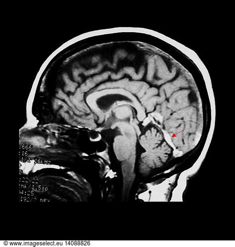 MRI of Dural Sinus Thrombosis MRI of Dural Sinus Thrombosis,abnormal ...