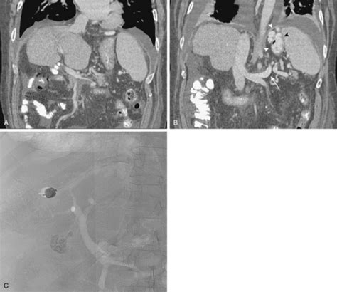 Hepatic Splenic And Portal Vascular Systems Radiology Key