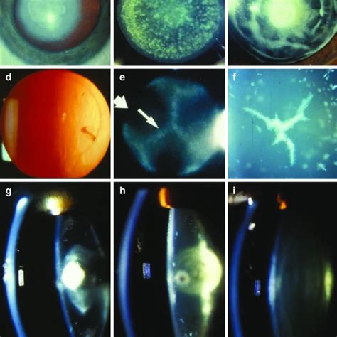 1 Examples Of Cataract Morphologies A Dense Nuclear Cataract The