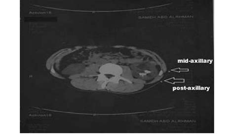 The small arrow refers to the mid-axillary line, while the large arrow ...